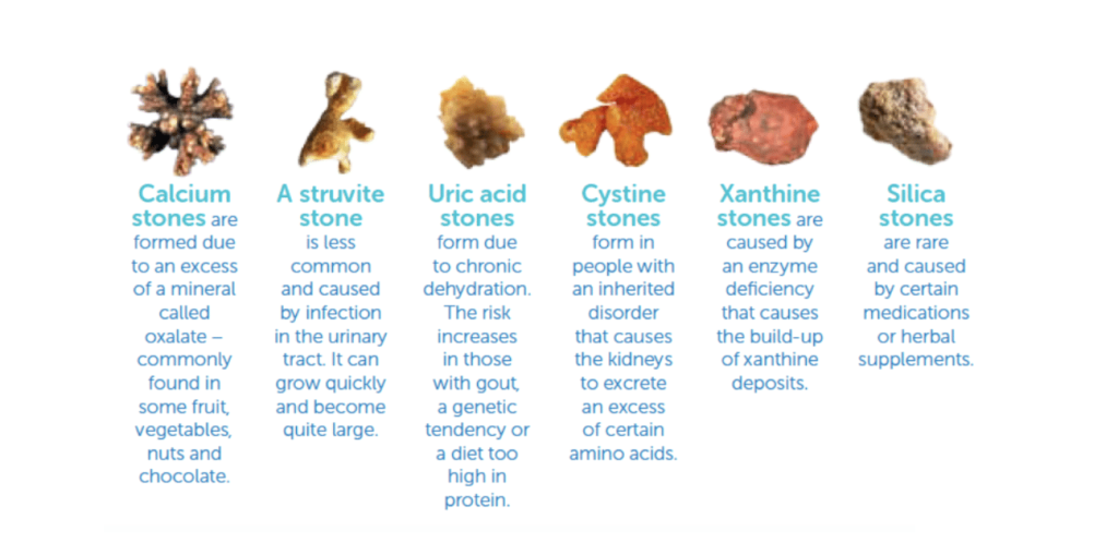Types of kidney stones