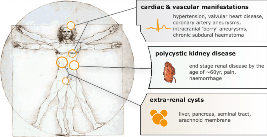 https://www.researchgate.net/figure/Manifestations-of-autosomal-dominant-polycystic-kidney-disease_fig1_49806892
