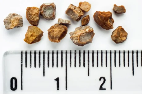 Natural Therapies To Treat Kidney Stones